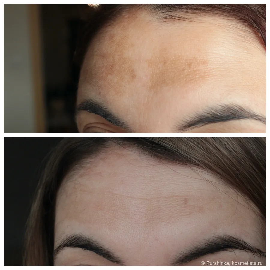 Effective Pigmentation Solutions with IPL Lumecca Review